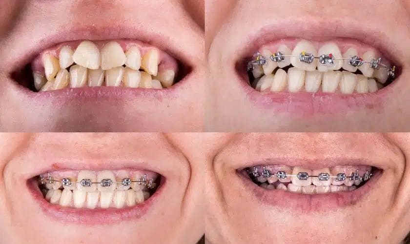 Progress photos of orthodontic braces treatment from start to finish