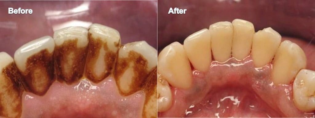 Before and after photo of ultrasonic scaling and polishing removing tartar and stain