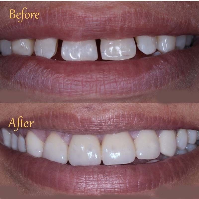 Before and after photo of a front teeth gap closed with porcelain veneers