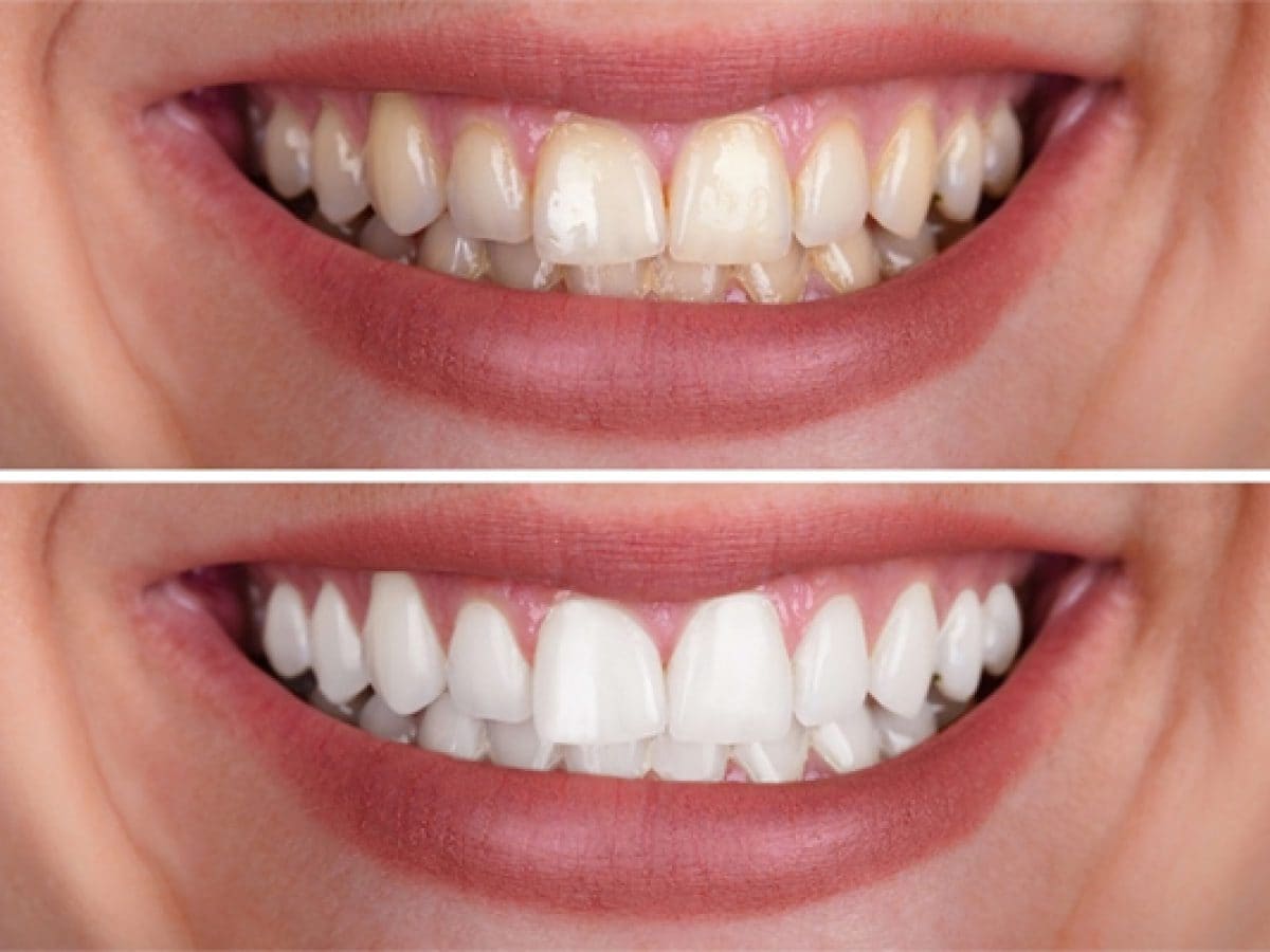 Before and after photo of professional in-clinic teeth whitening